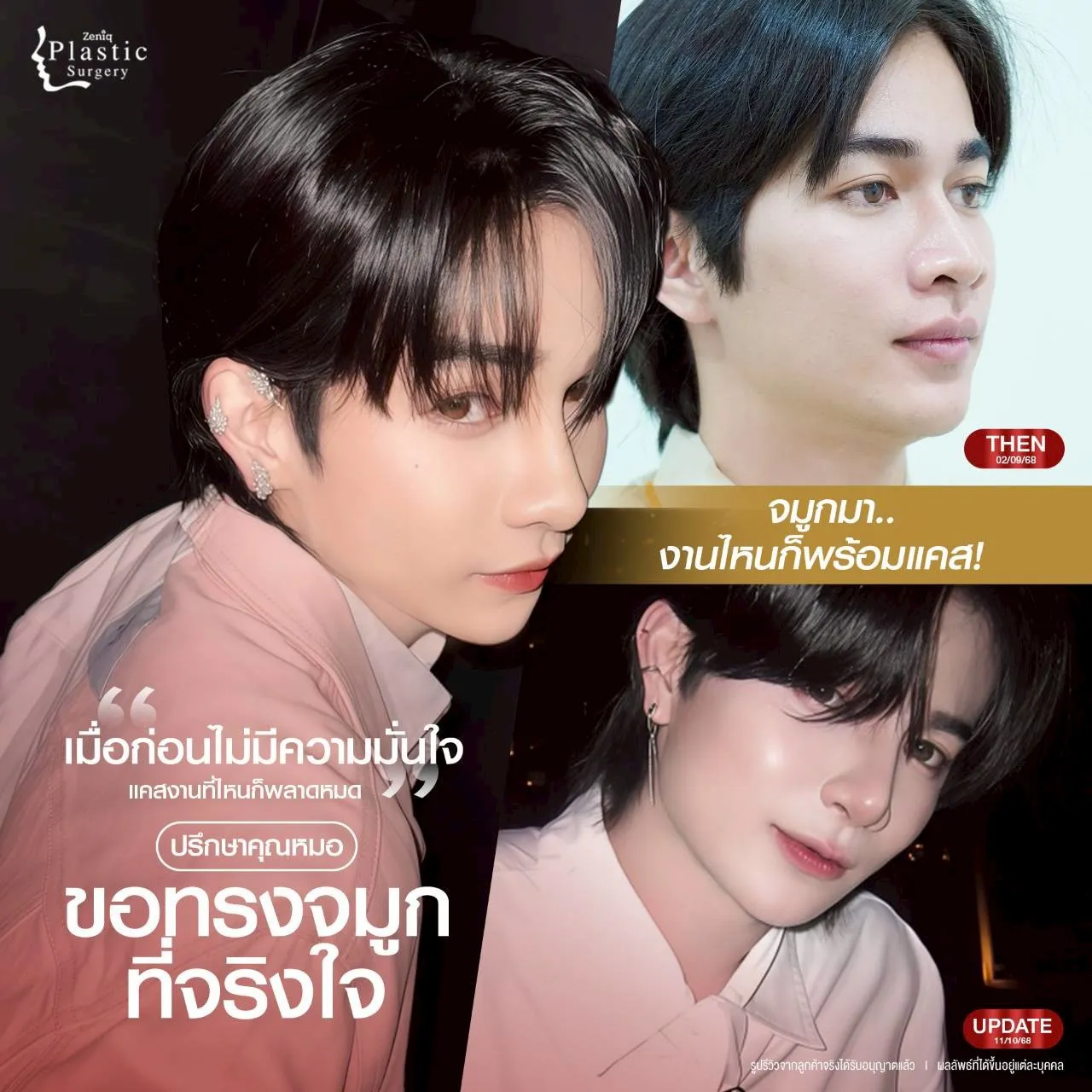 Zeniq Plastic Surgery Open Nose Surgery